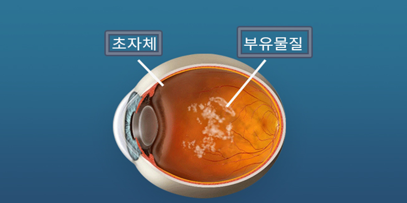 비문증 부유물