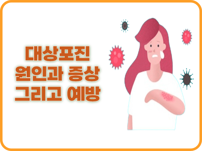 대상포진 원인과 증상 그리고 예방